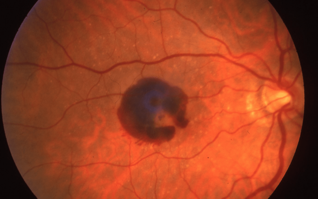 An Overview of Macular Degeneration 