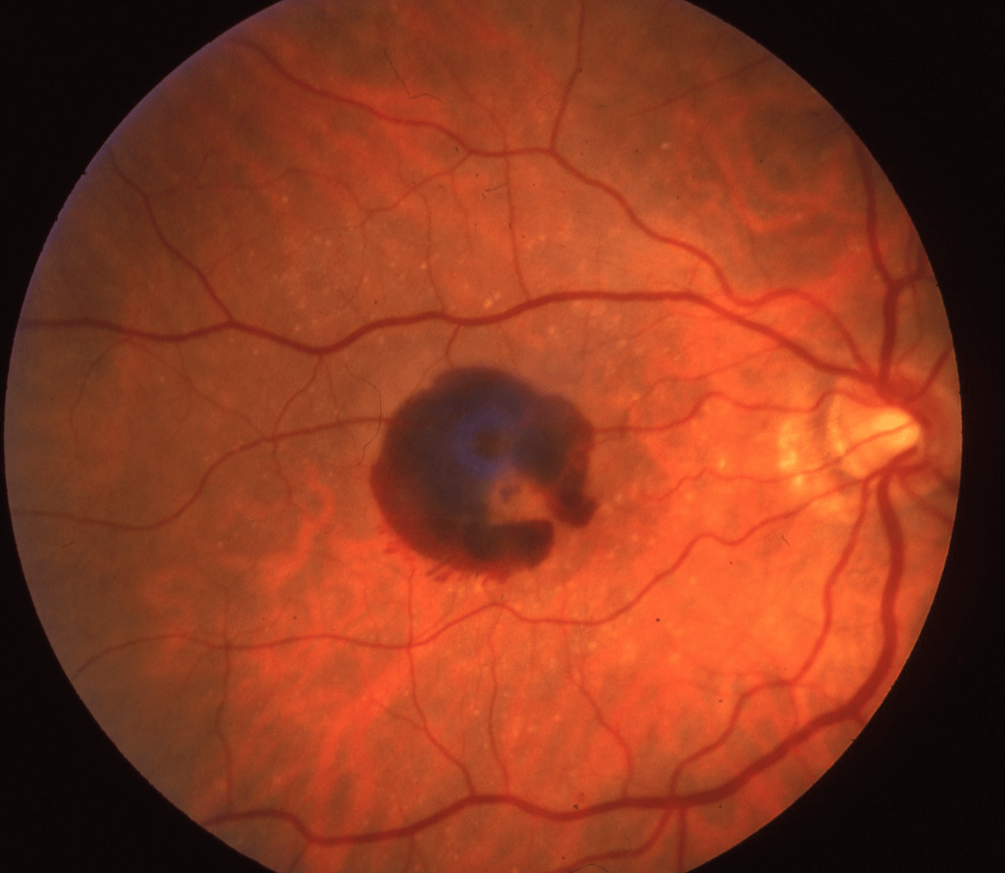 An Overview Of Macular Degeneration EyeDocs Family Eye Care