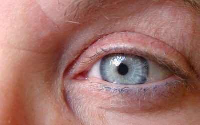 What is Ocular Albinism and How Can it Affect the Eyes?