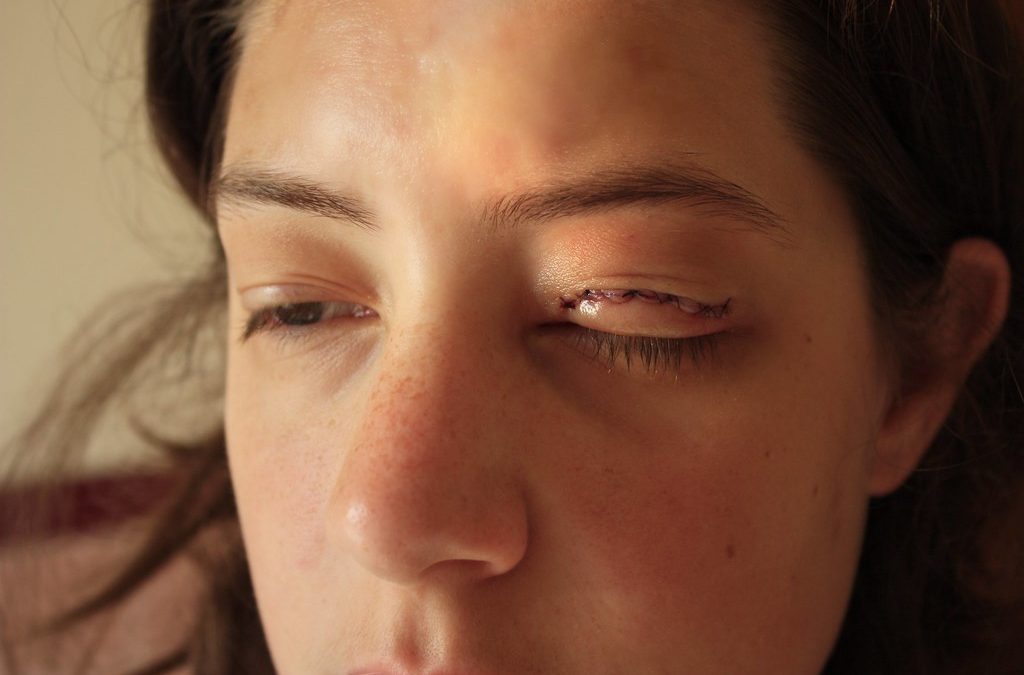 What is the Recovery for Droopy Eyelid Surgery?